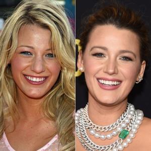 Hollywood stars are ruining their looks and damaging their teeth